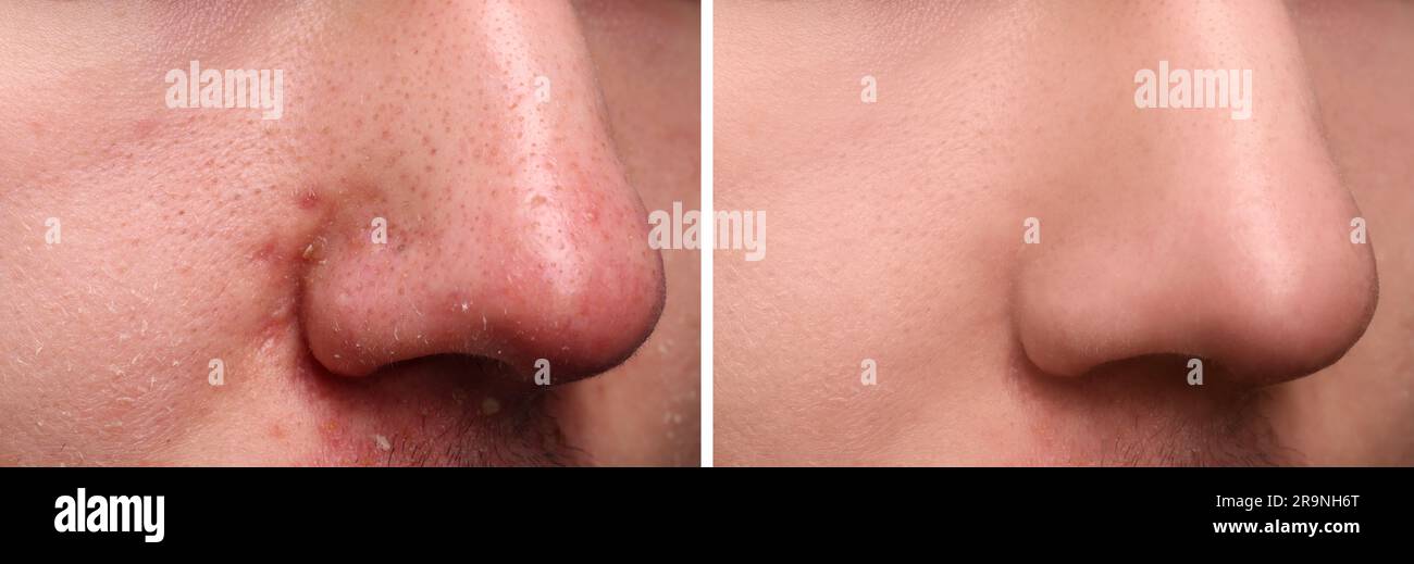 Photos of man before and after acne treatment, closeup. Collage showing ...