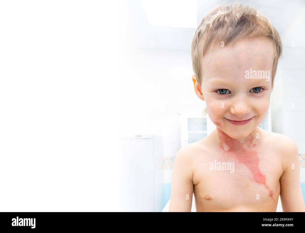 dressing a boy with a burn from boiling water Stock Photo Alamy