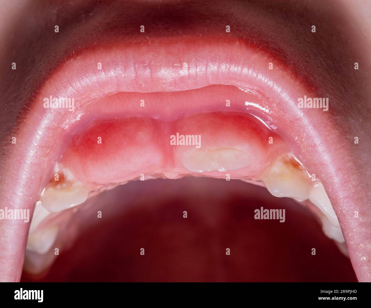 Swelling of the gums during the eruption of permanent teeth after the
