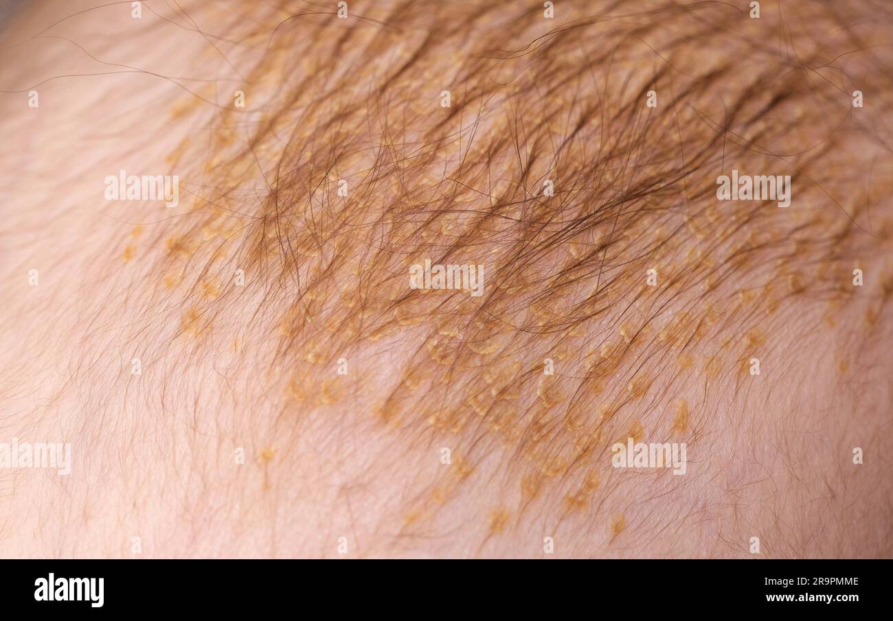 the process of formation of seborrheic dermatitis in an infant on the