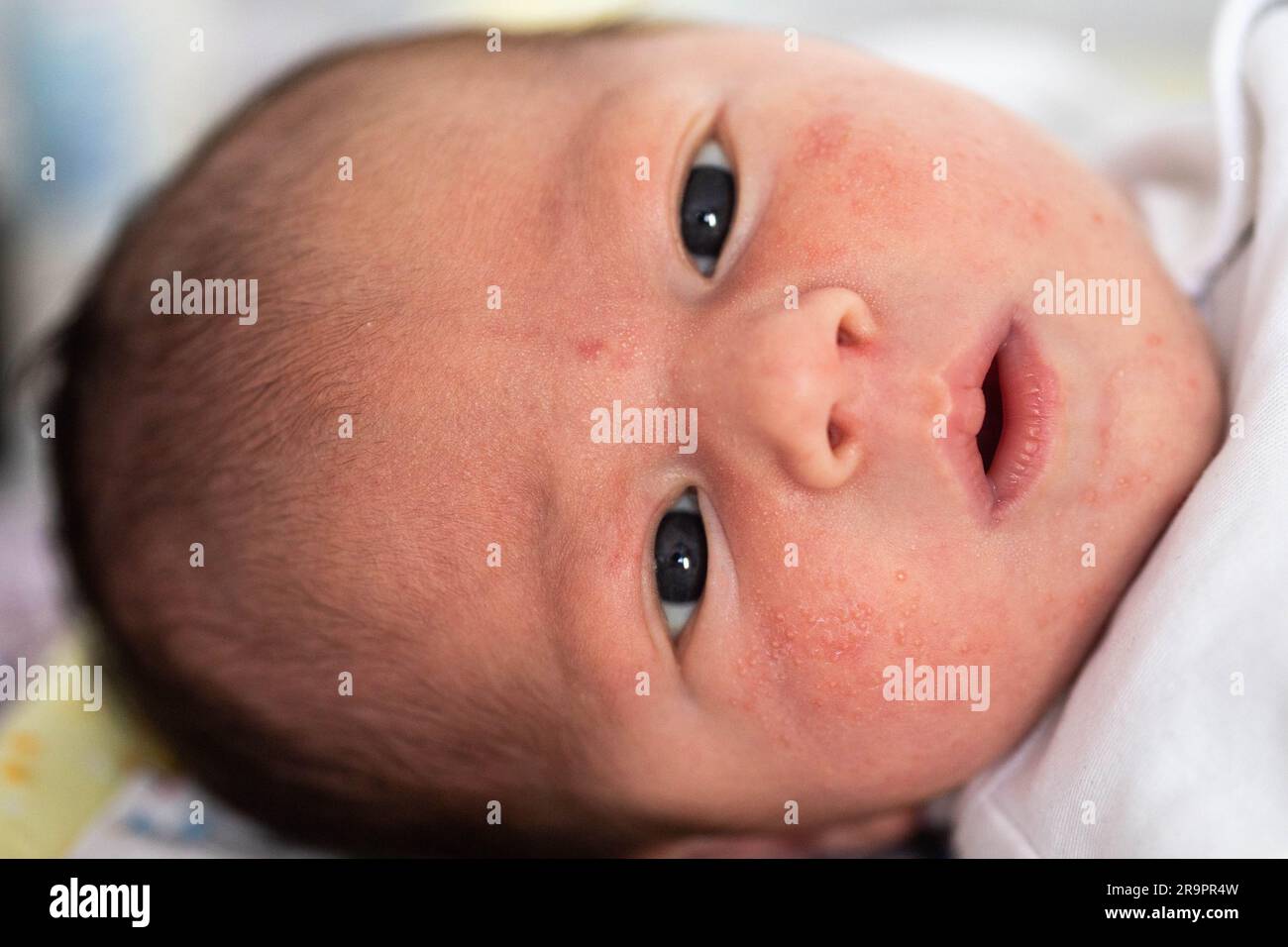 Rash on the face of a newborn baby. The process of formation of the ...