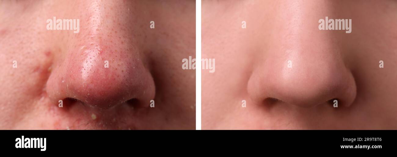 Photos of man before and after acne treatment, closeup. Collage showing ...