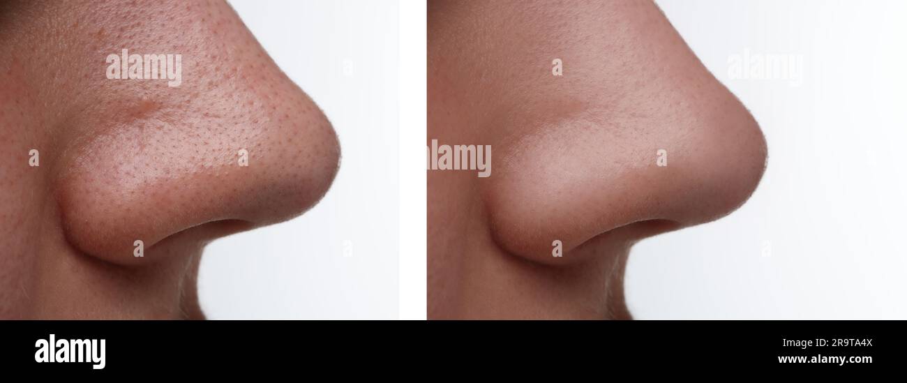 Before and after acne treatment. Photos of woman on white background, closeup. Collage showing affected and healthy skin Stock Photo