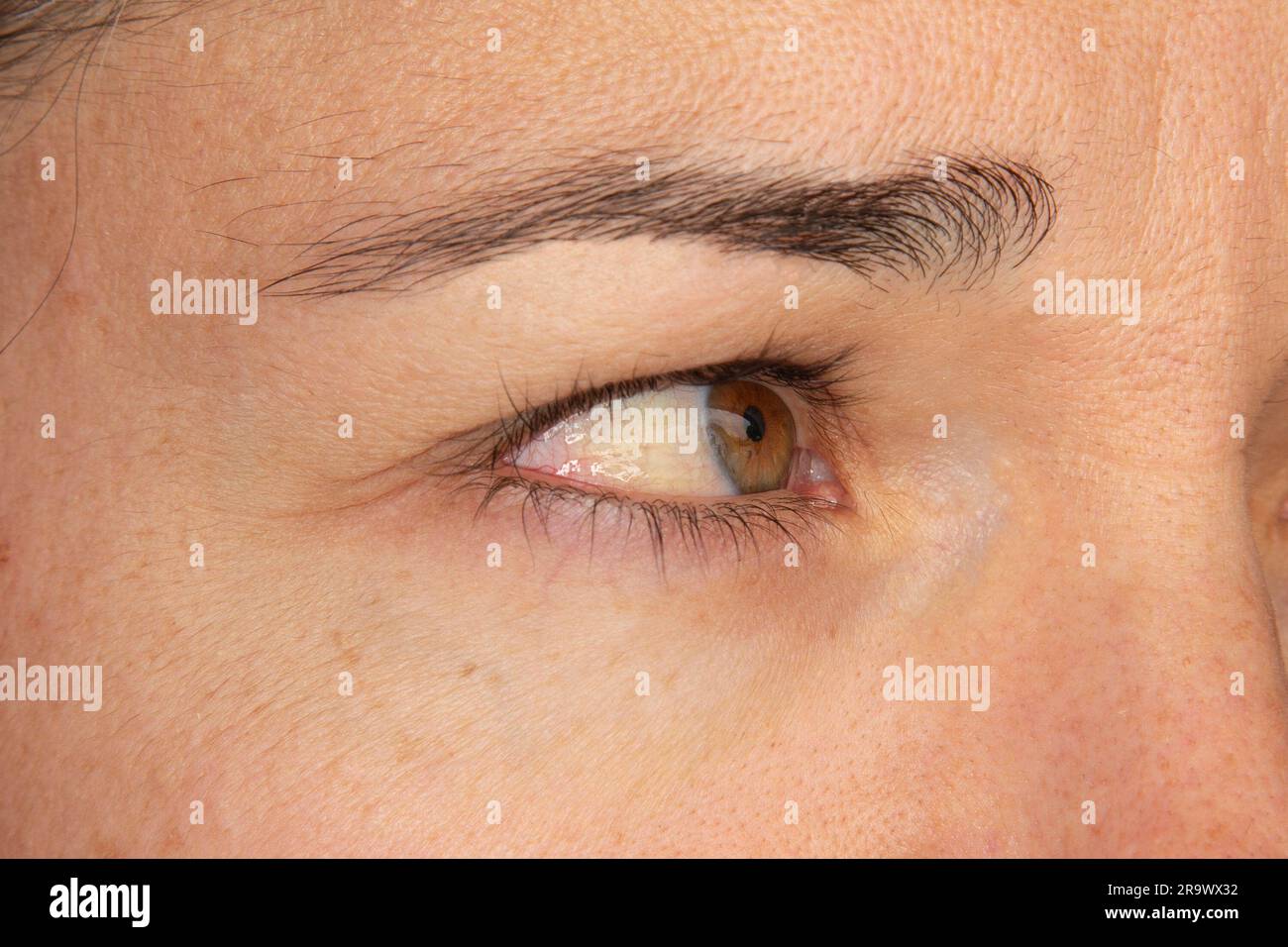 Chemosis hi-res stock photography and images - Alamy