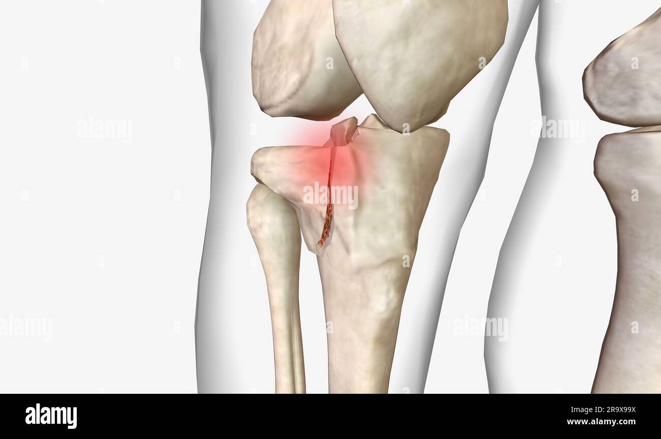 Knee osteoarthritis 3d scan hi-res stock photography and images - Alamy