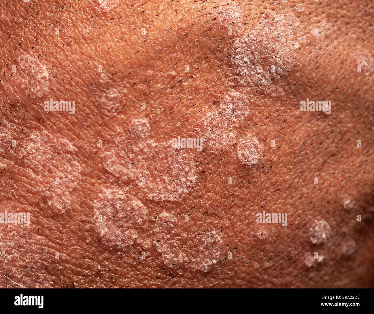 Close-up view of fungal infection of scalp hair. Tinea capitis, ringworm or herpes tonsurans infection. Stock Photo