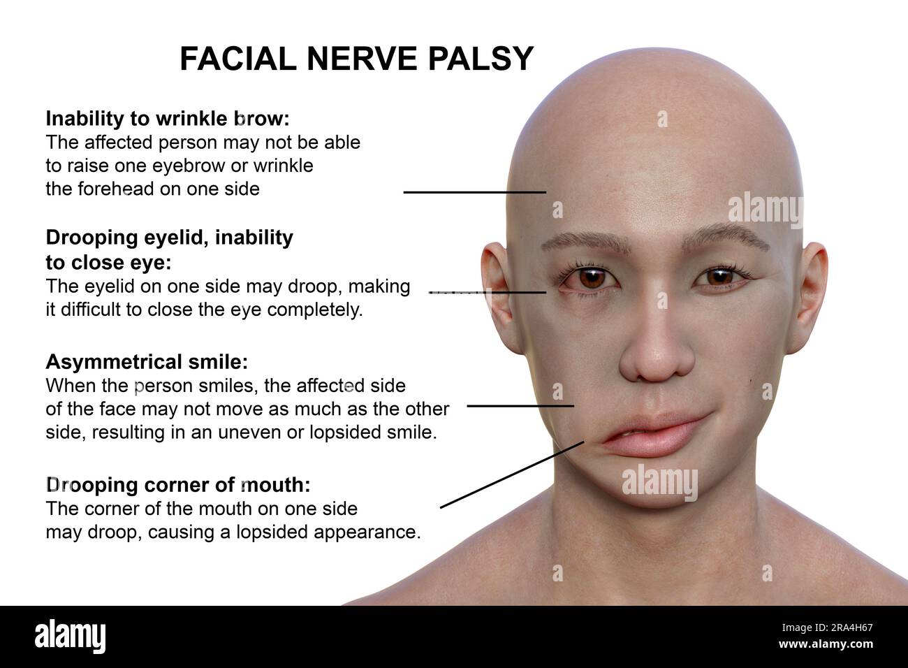 What Causes The Right Side Of The Face To Droop