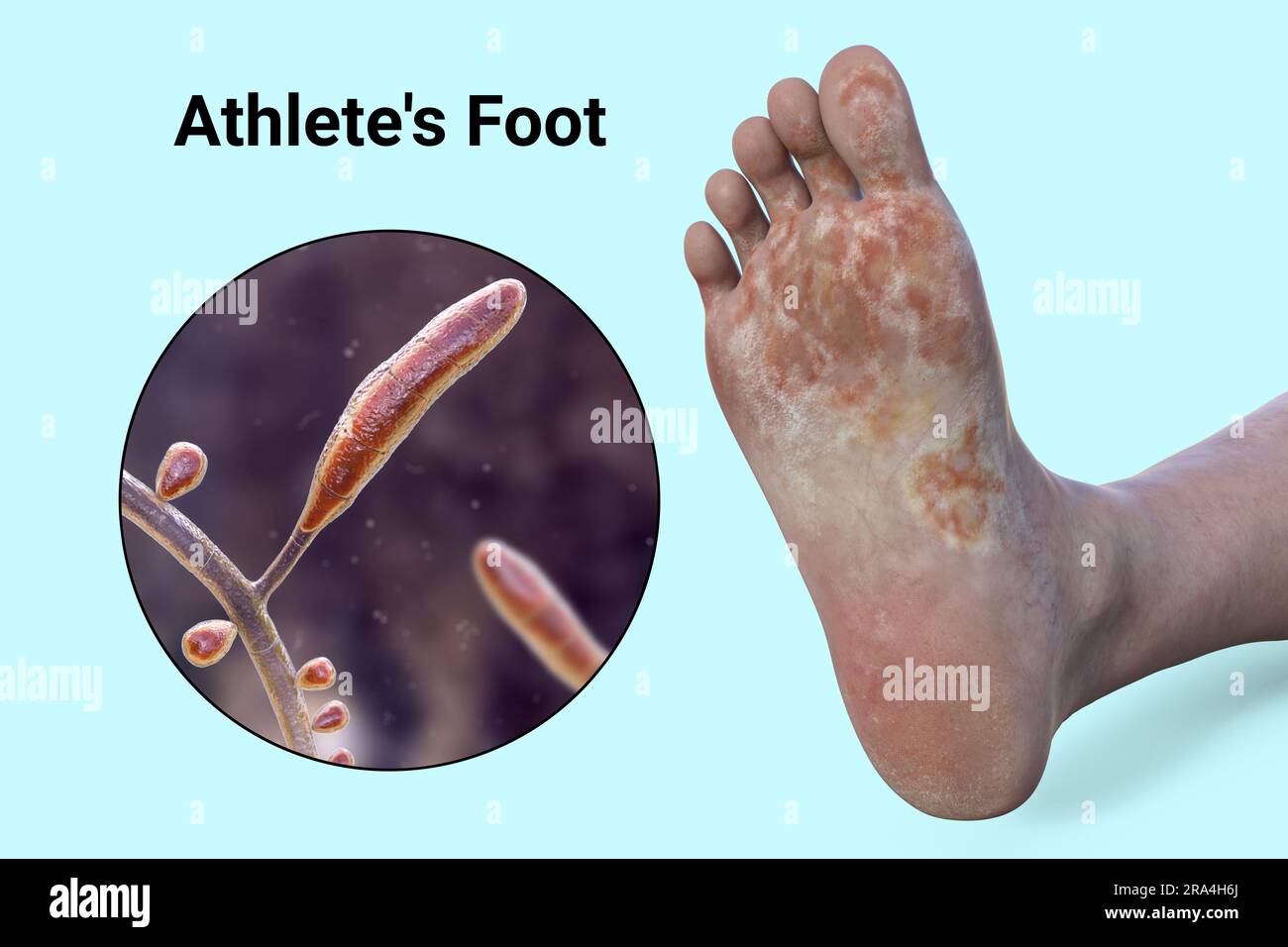 Athlete's foot, illustration Stock Photo