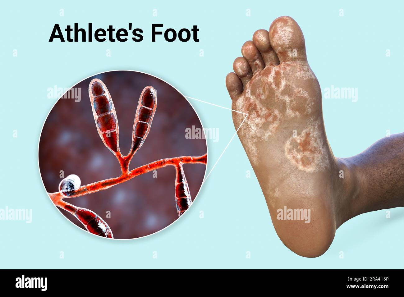 Athlete s Foot Illustration Stock Photo Alamy Athlete s Foot Illustration Stock Photo Alamy