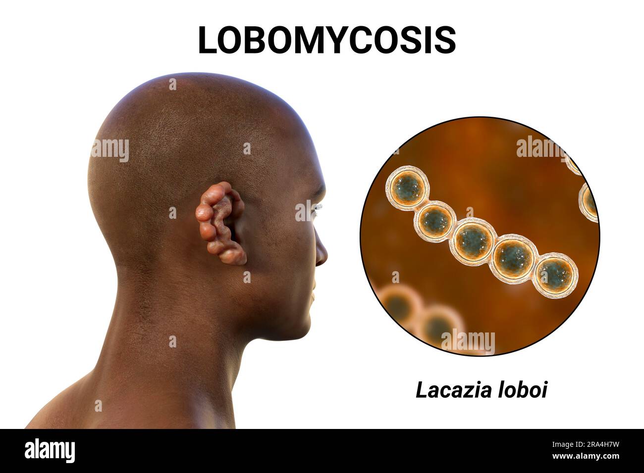 Lobomycosis fungal infection, illustration Stock Photo