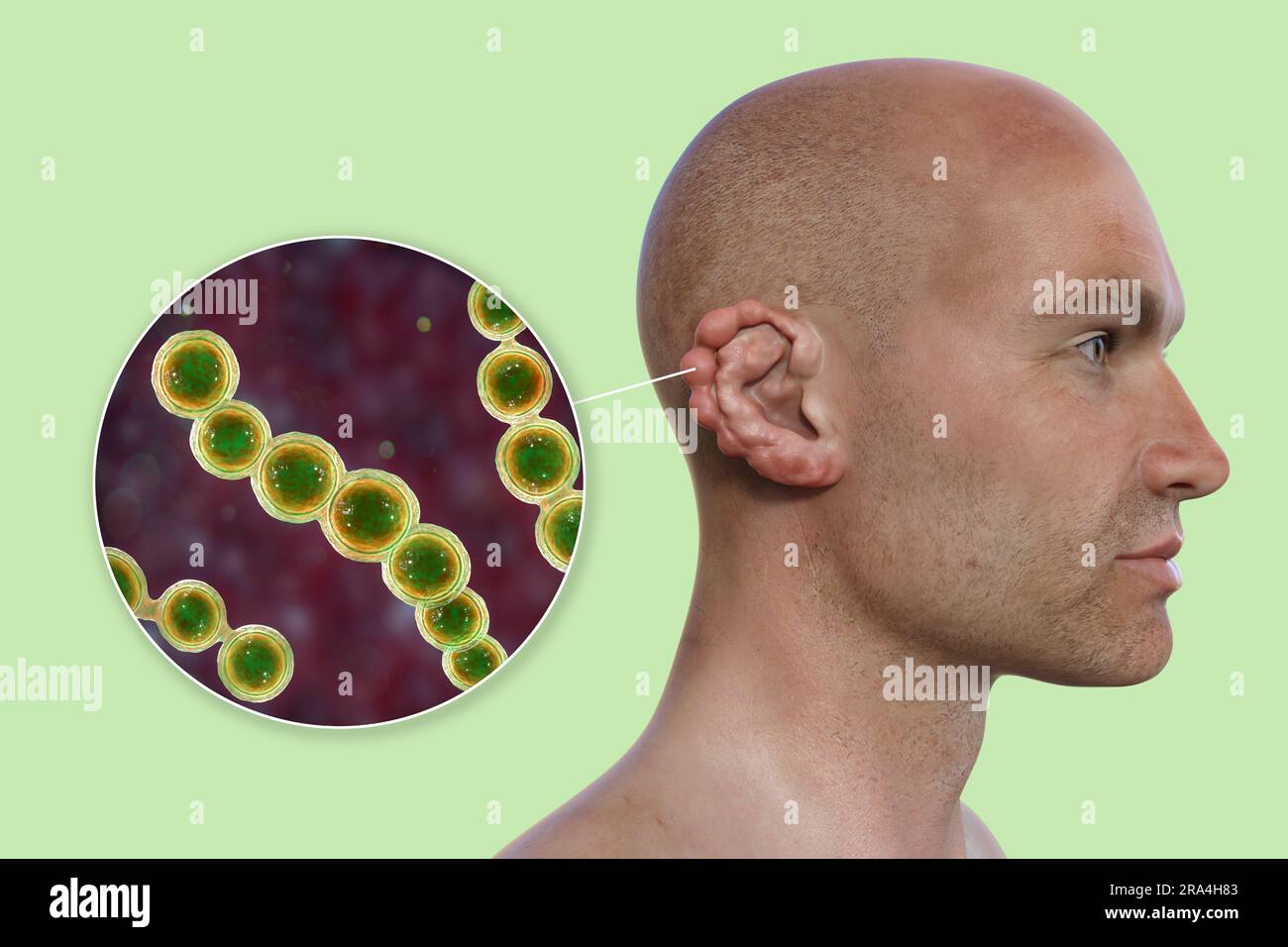 Lobomycosis fungal infection, illustration Stock Photo Alamy