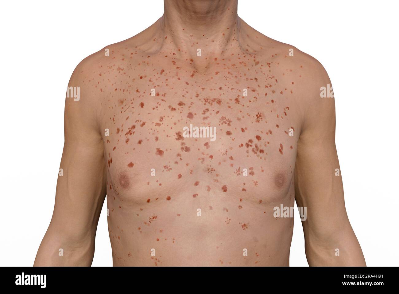 Rash in Marburg haemorrhagic fever, illustration Stock Photo - Alamy