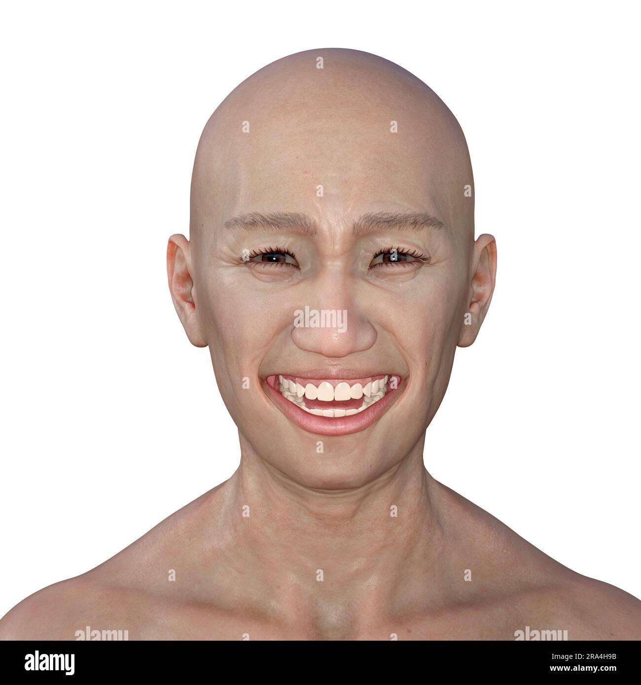 Lockjaw in tetanus, illustration Stock Photo Alamy