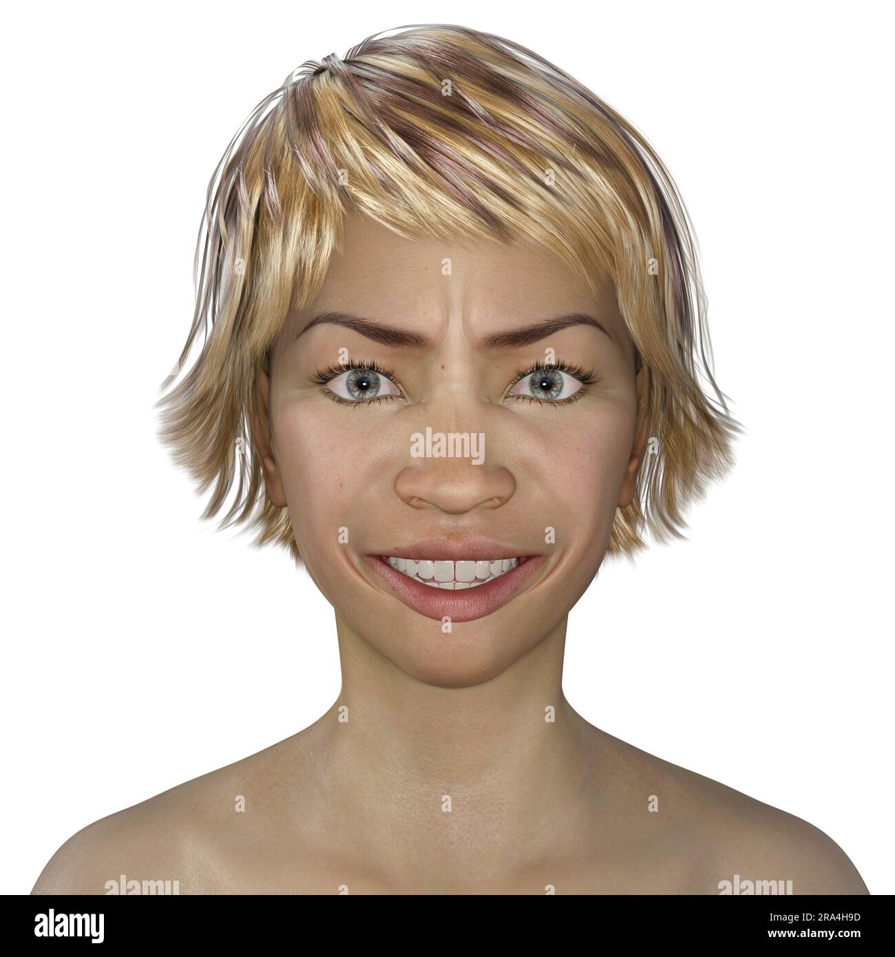 Lockjaw in tetanus, illustration Stock Photo Alamy