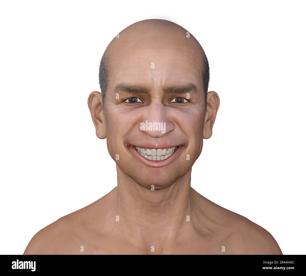 Lockjaw in tetanus, illustration Stock Photo Alamy