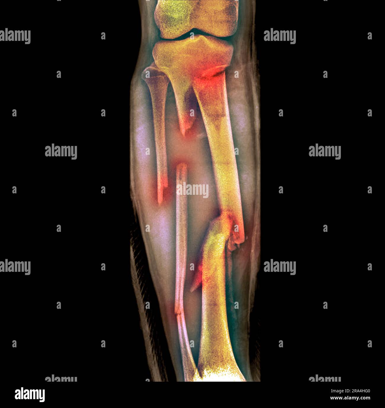 Fractured leg, X-ray Stock Photo - Alamy