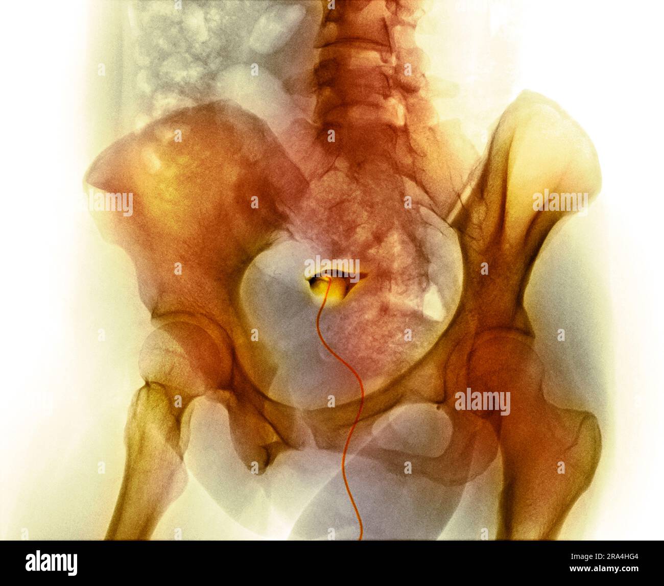 Blocked fallopian tube, X-ray Stock Photo