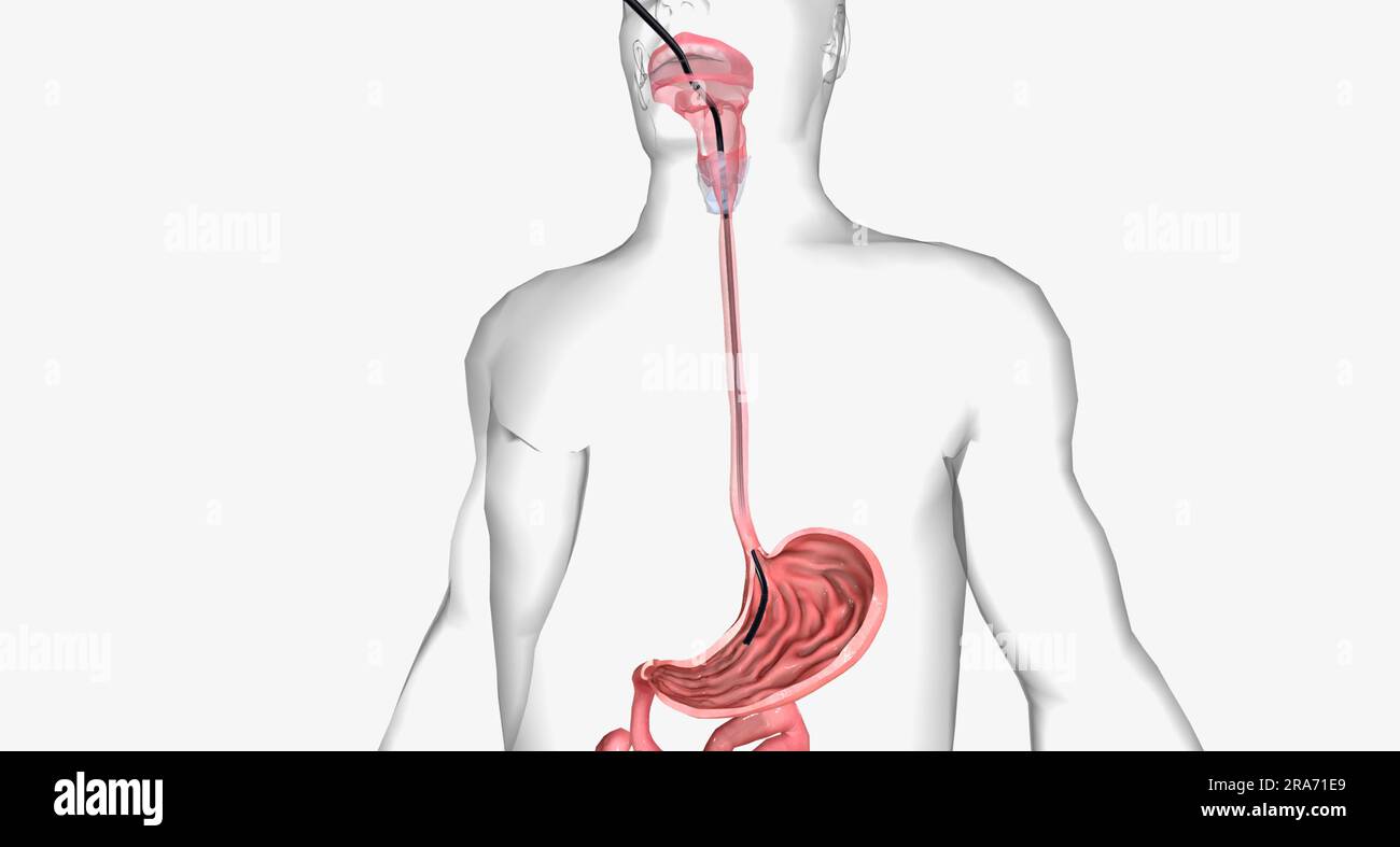 An upper endoscopy or EGD is an invasive procedure used to look inside