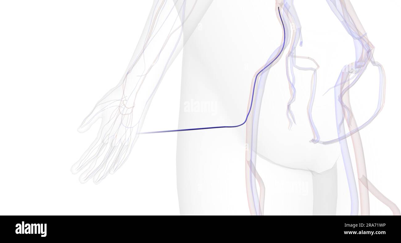 The Minimally Invasive Access for Embolectomy 3D rendering Stock Photo