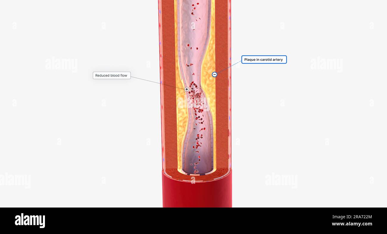 A Narrowed Carotid Artery Can Cause Reduced Blood Flow To The Brain 3D a-narrowed-carotid-artery-can-cause-reduced-blood-flow-to-the-brain-3d
