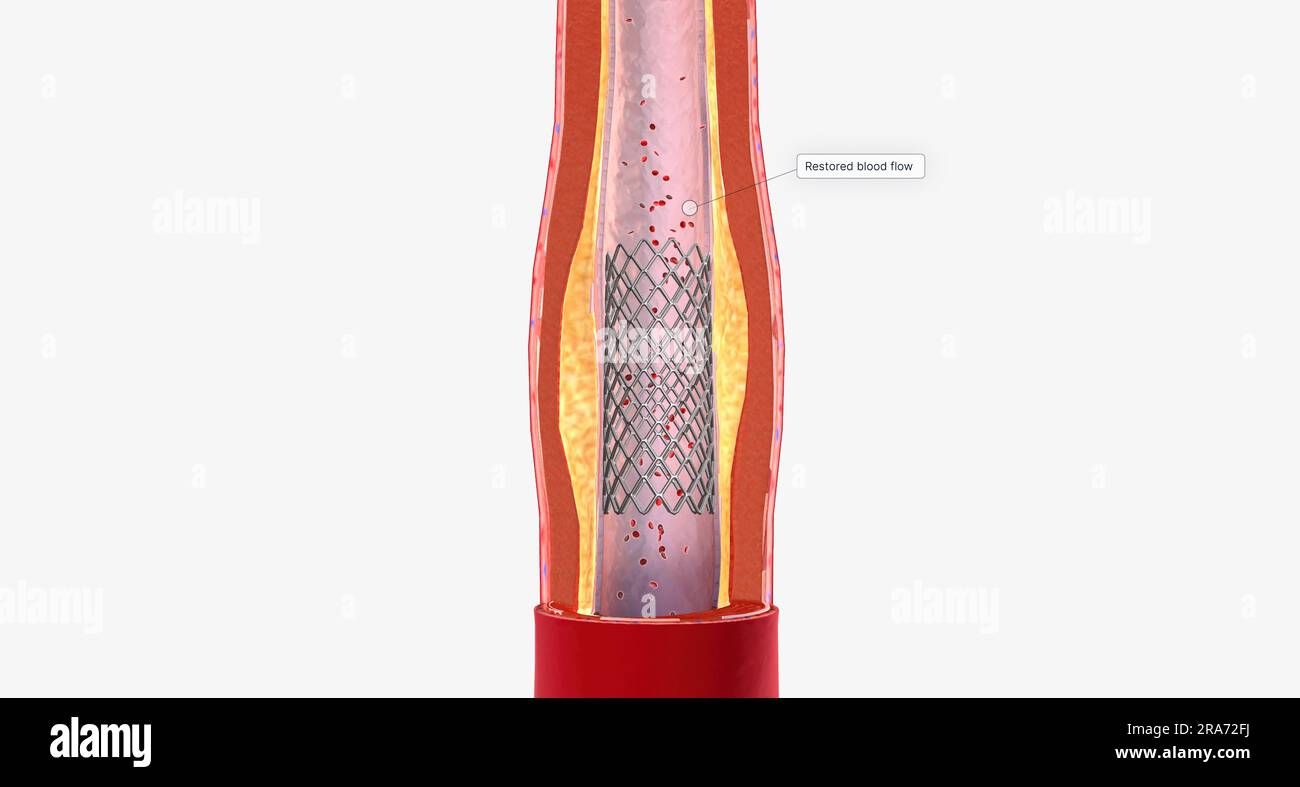 The balloon catheter expands the stent which widens the carotid artery
