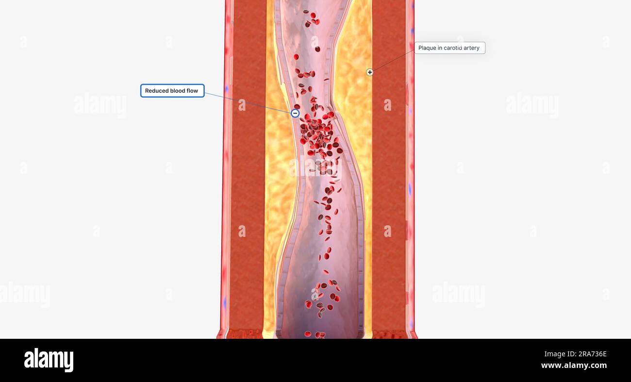 A Narrowed Carotid Artery Can Cause Reduced Blood Flow To The Brain 3D a-narrowed-carotid-artery-can-cause-reduced-blood-flow-to-the-brain-3d