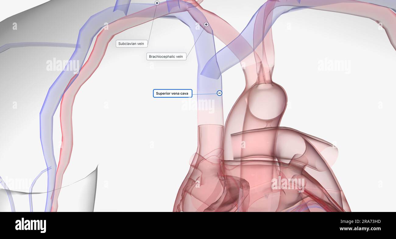 A central venous catheter is a thin, flexible tube inserted into one of