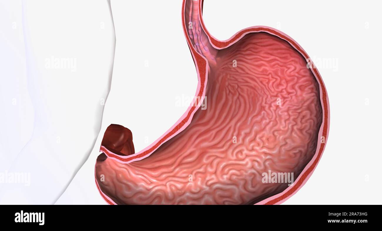 Esophageal varices are extremely dilated submucosal veins in the lower