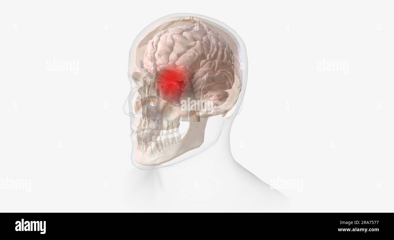 Cluster headaches are a rare and extremely painful type of headache. 3D