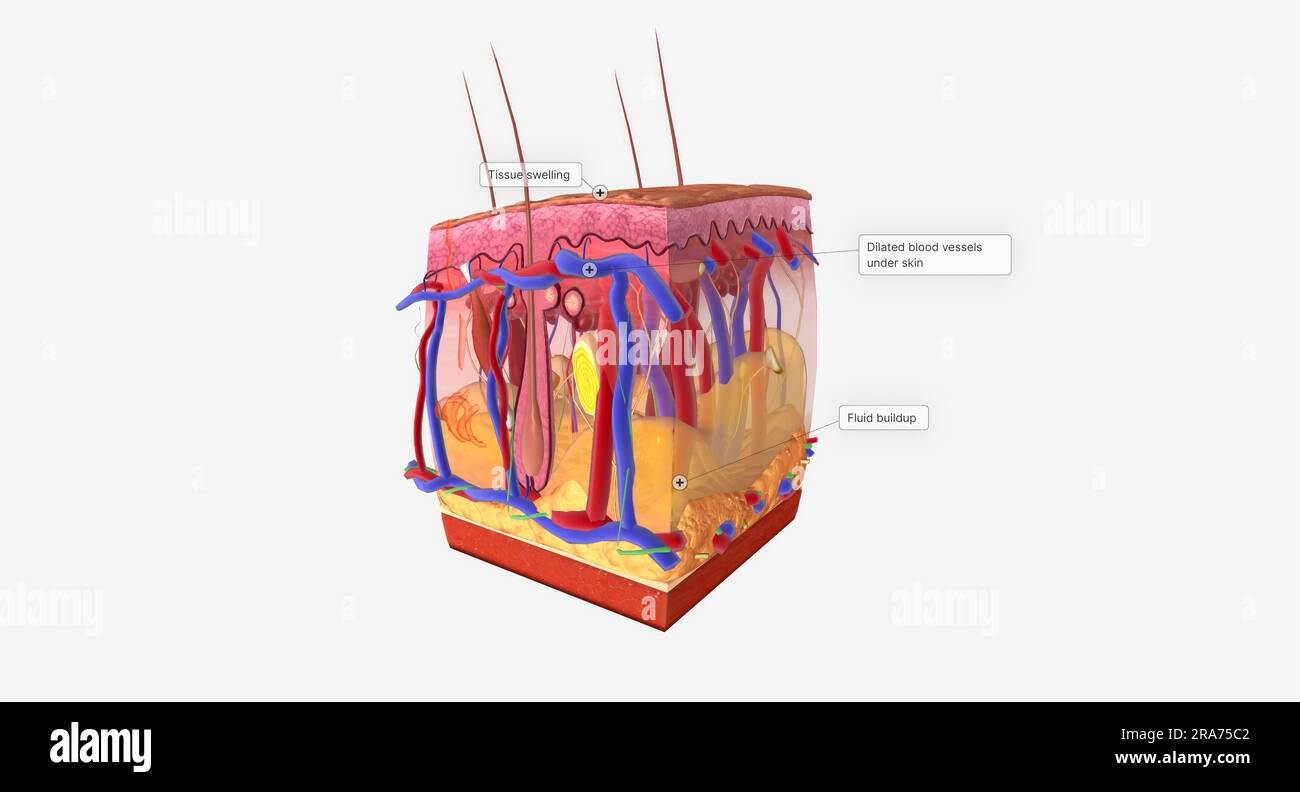 Angioedema is a swelling of the dermis and subcutaneous tissue