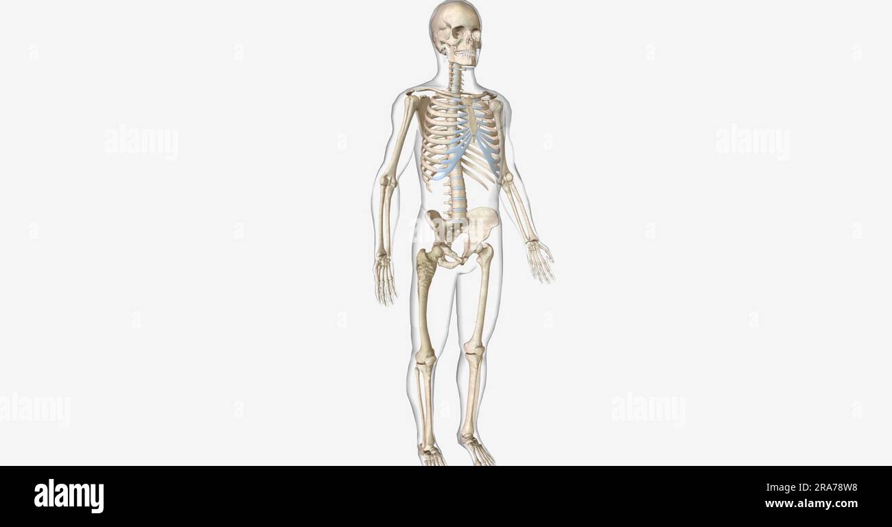 Paget's disease of the bone (PDB) is a skeletal disorder characterized