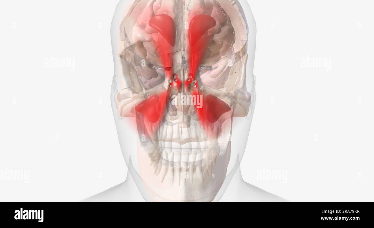 Sinus headaches are a type of headache characterized by a dull ache or
