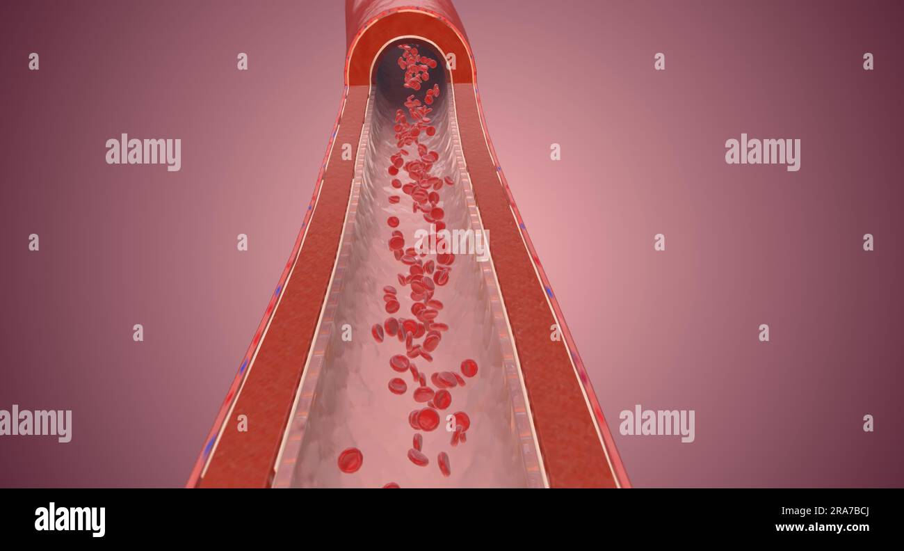 Hypertension causes high blood pressure when the force exerted by the