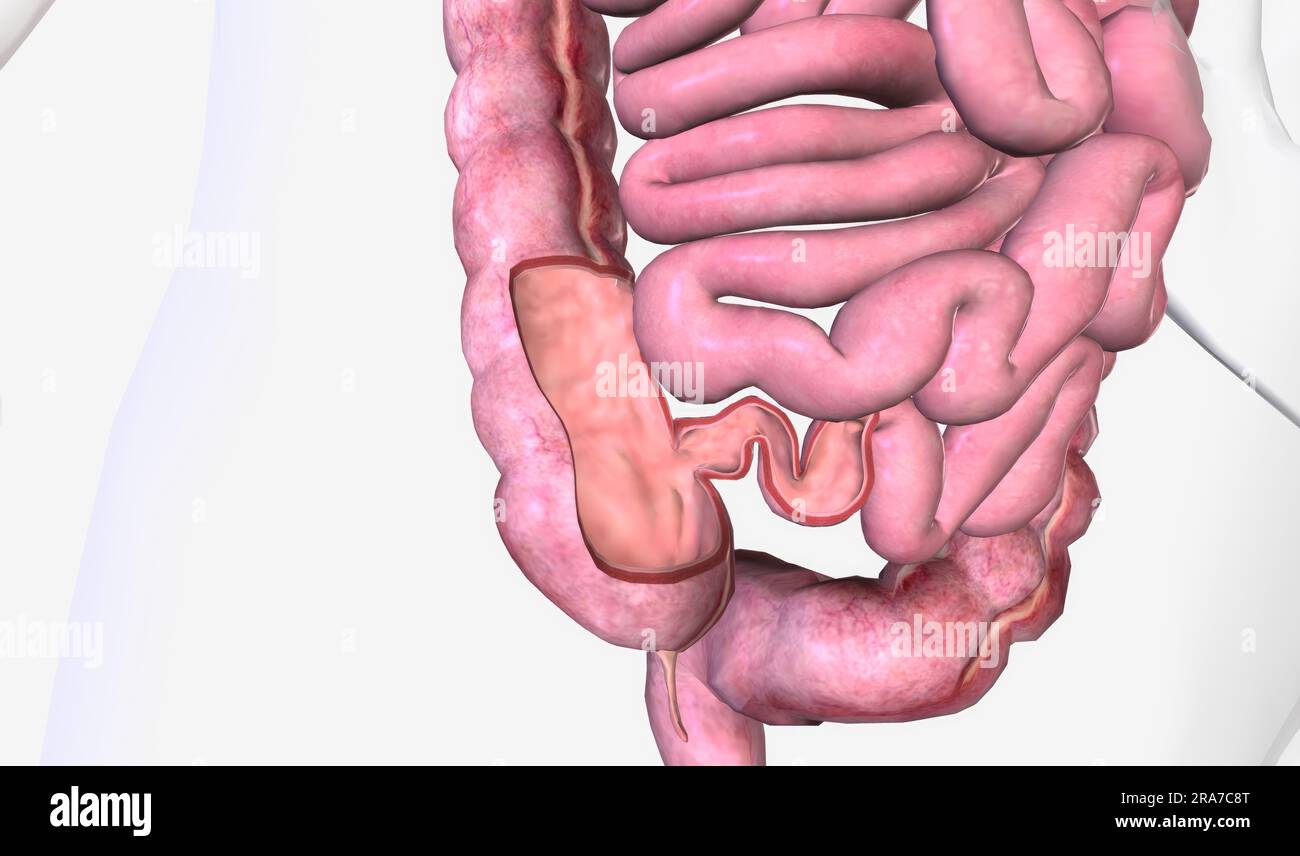 The ileocecal valve is a papillose structure with a physiological
