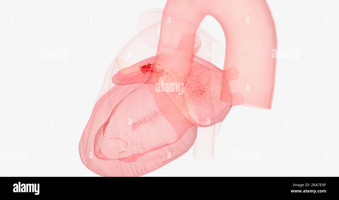 With atrial fibrillation, blood can get trapped in the small left