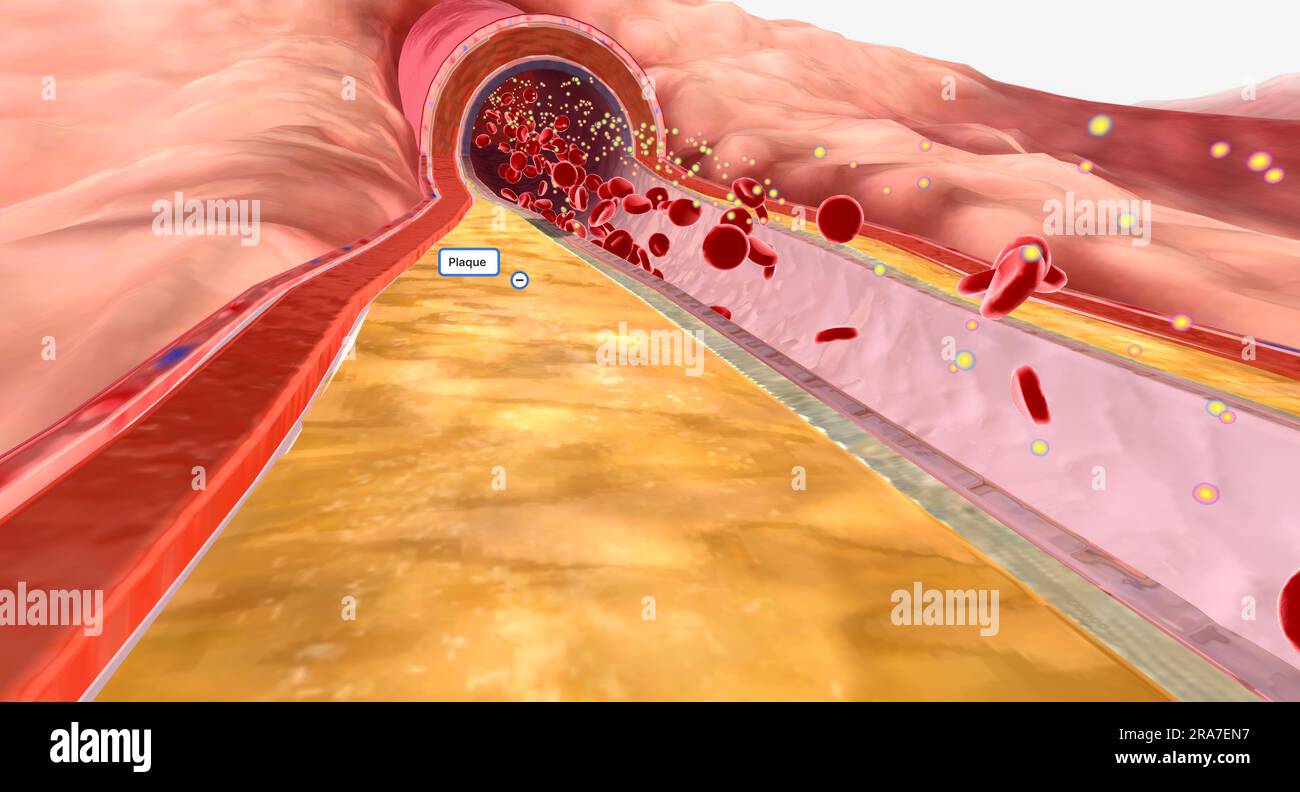 In hyperlipidemia, excess lipids can build up on artery walls and form