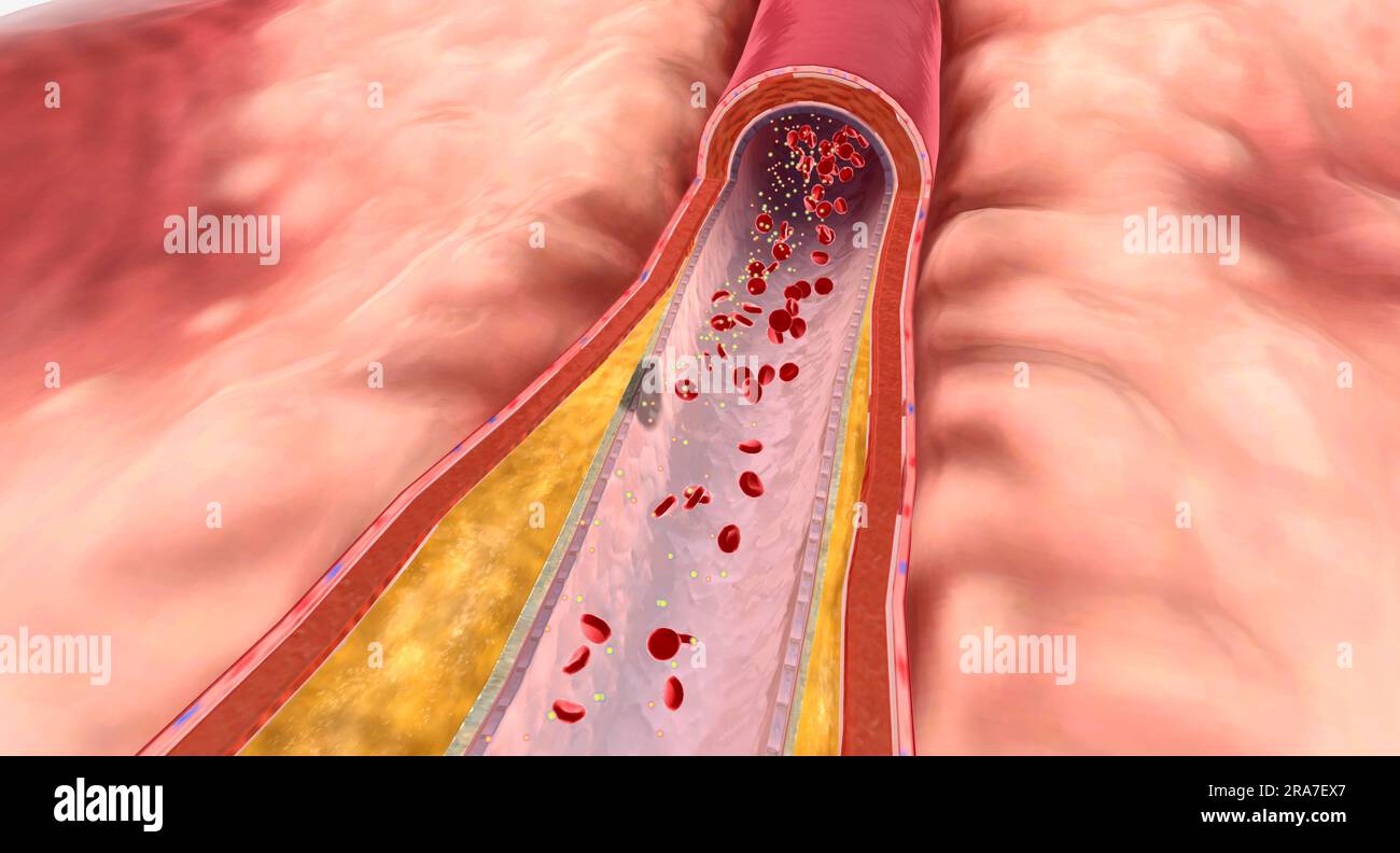 In hyperlipidemia, excess lipids can build up on artery walls and form