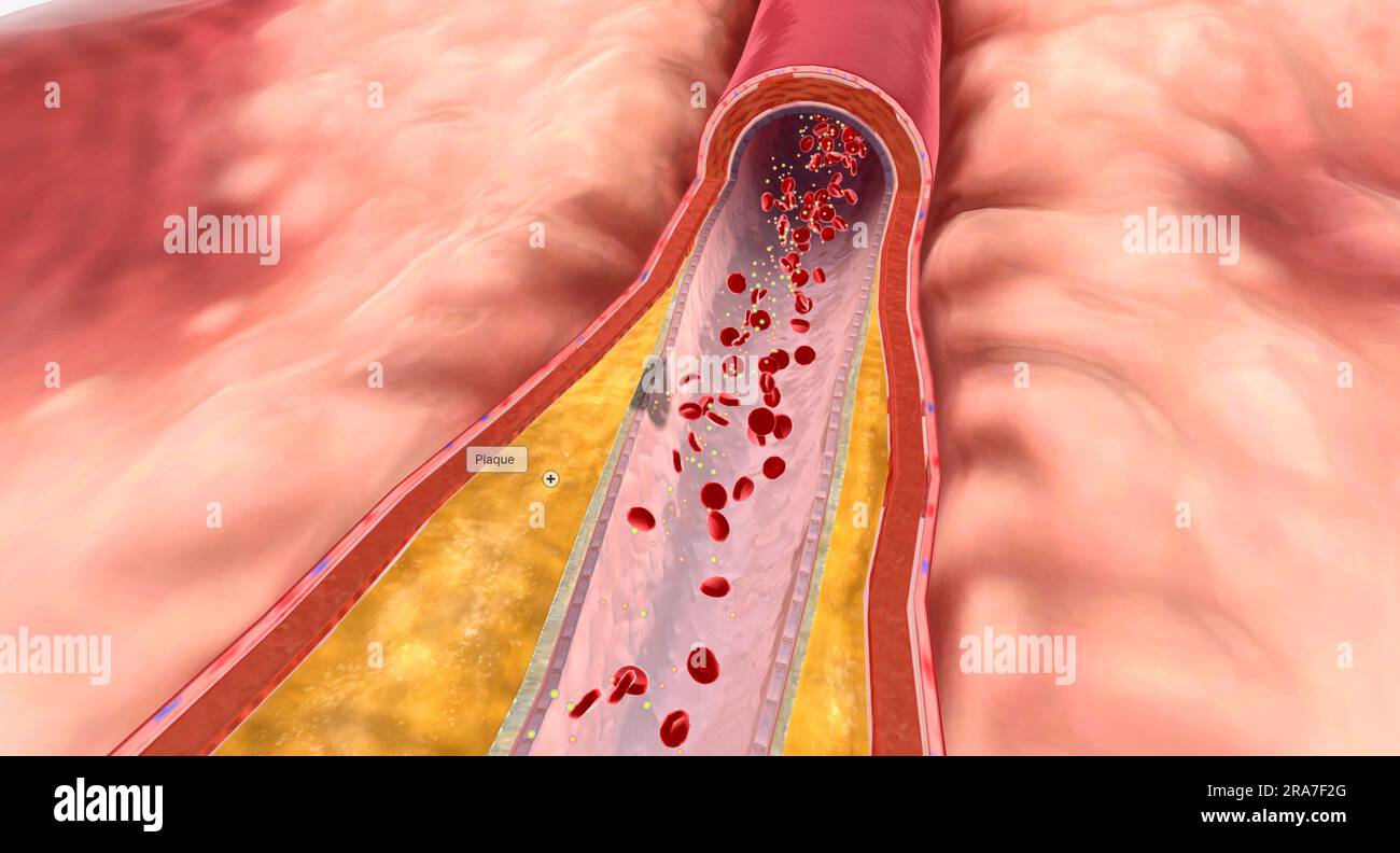 In hyperlipidemia, excess lipids can build up on artery walls and form