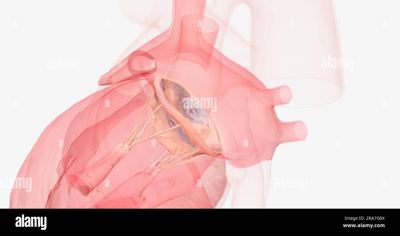 Mitral valve prolapse may cause the blood to flow backwards from the