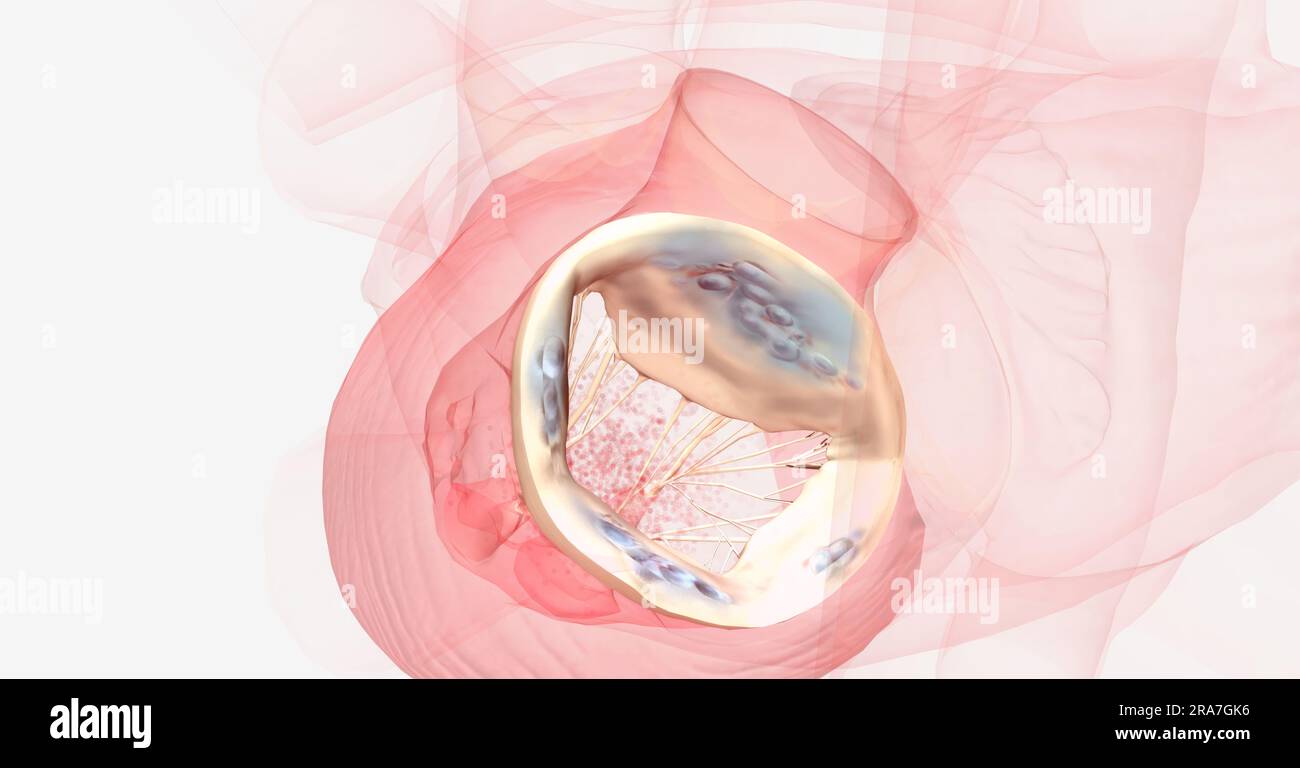 The backwards flow of blood increases the amount of blood in the left