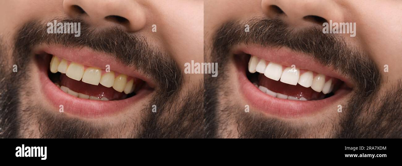 Collage with photos of man before and after tooth whitening, closeup ...