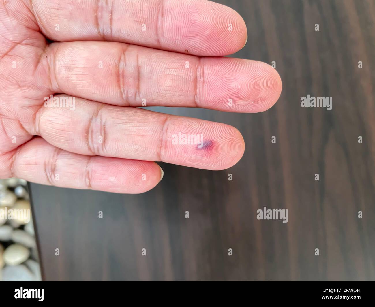 Hematoma formation on the finger caused by being hit by a door Stock