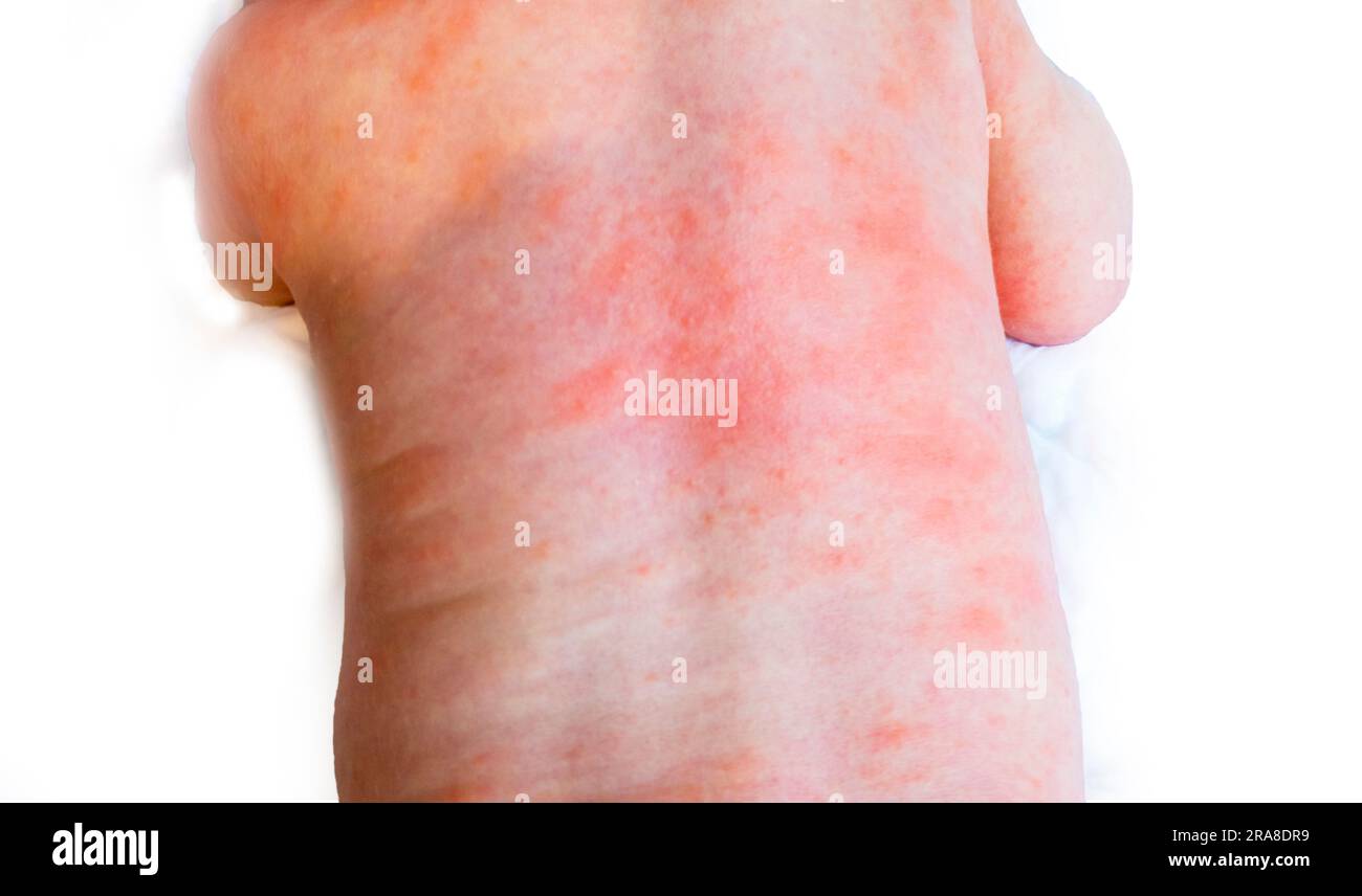 baby allergy skin. child dermatitis symptom problem rash. suffering