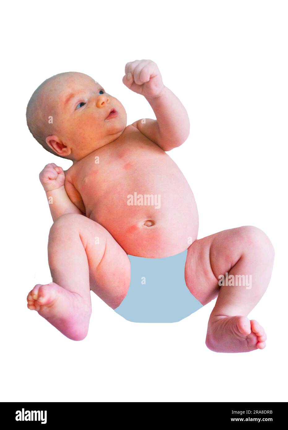 baby allergy skin. child dermatitis symptom problem rash. suffering