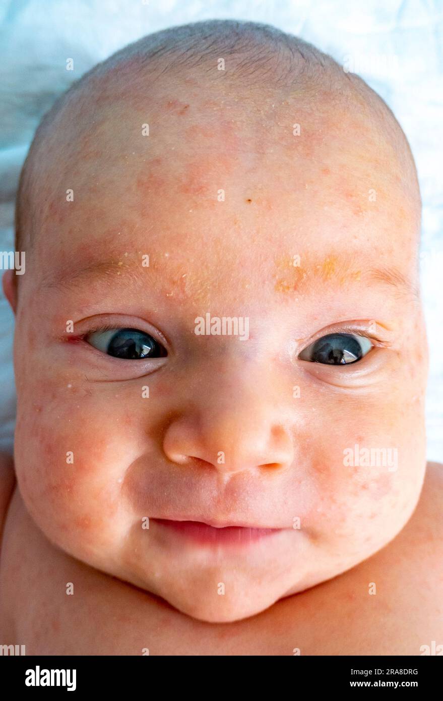 baby allergy skin. child dermatitis symptom problem rash. suffering