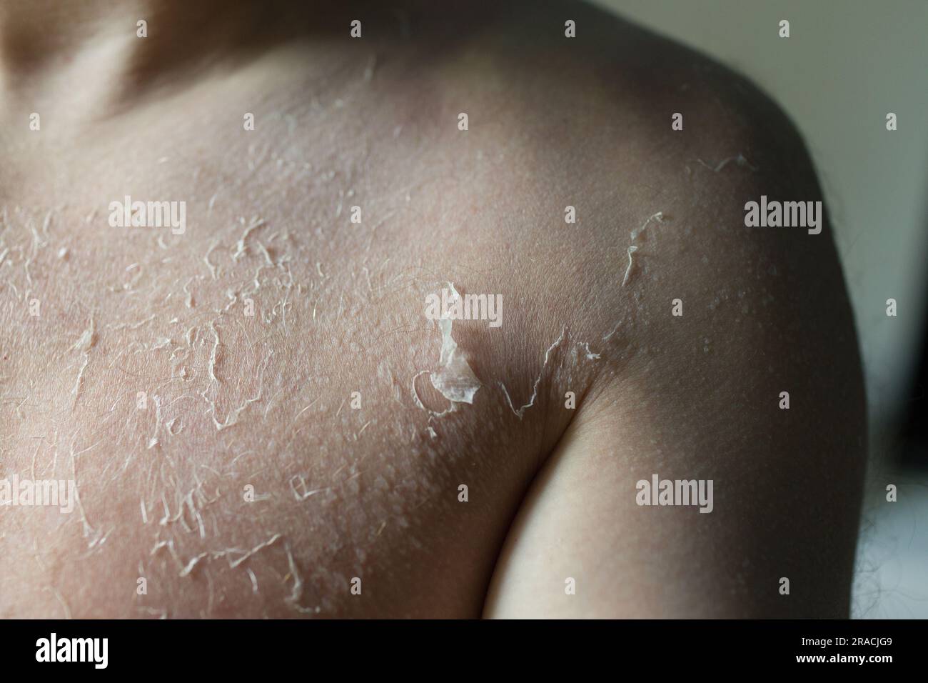 Peeling skin sun hires stock photography and images Alamy