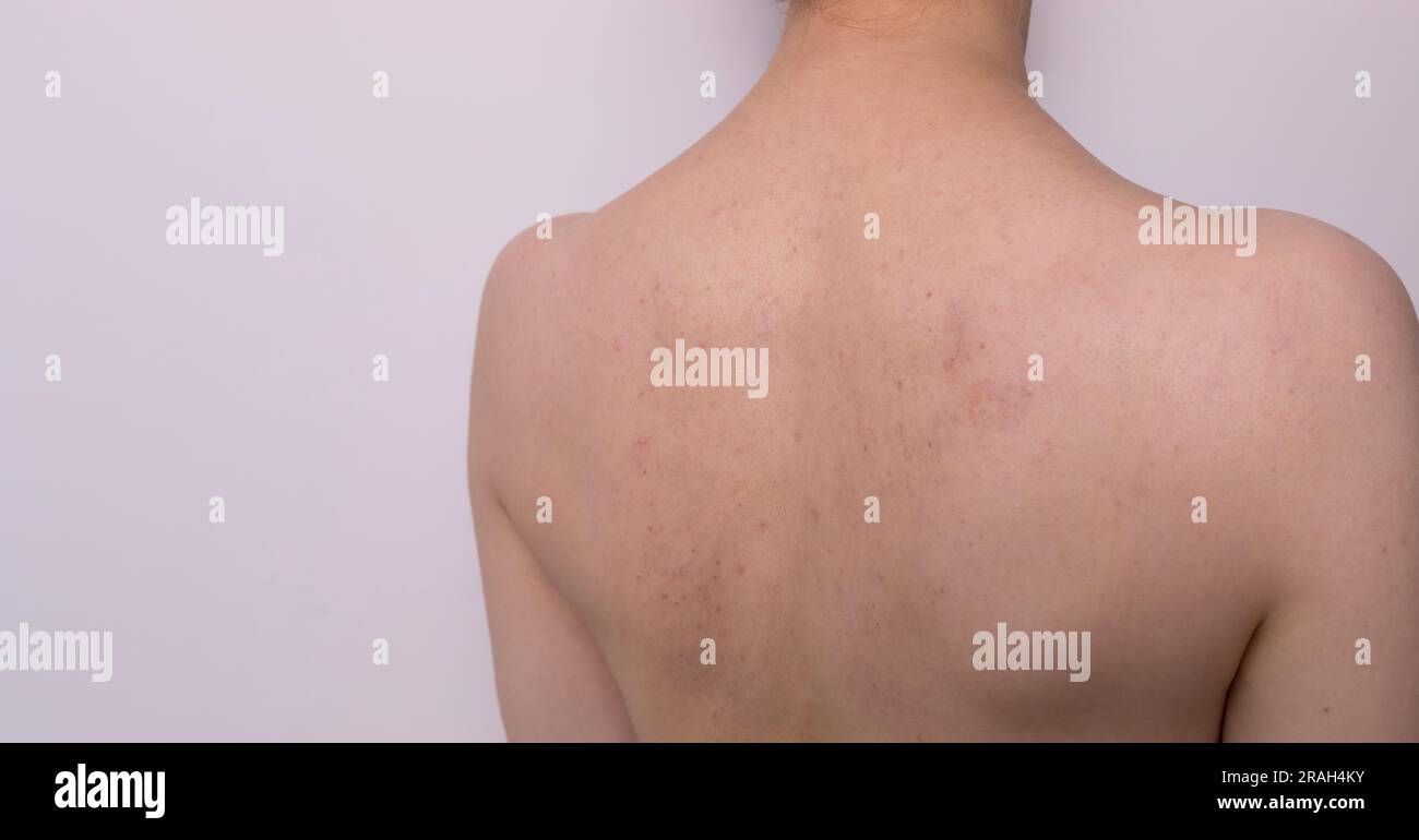 Closeup Bruises, Broken Capillaries After Cupping, Anti Cellulite Massage Procedure On Patient