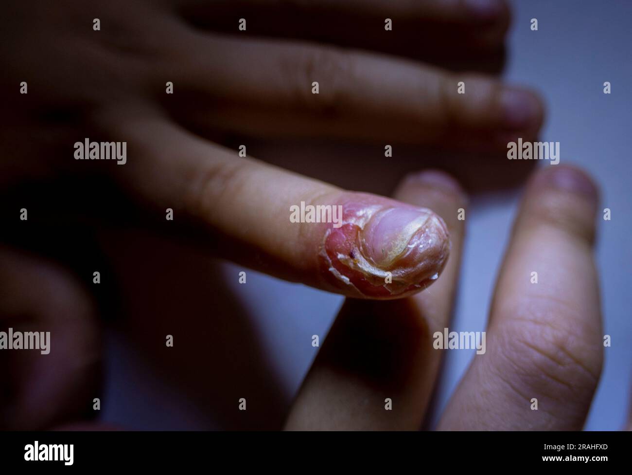 Finger swollen with inflammation due to Nail ripped infection, Finger with  pus next to fingernail called Paronychia Stock Photo | Adobe Stock