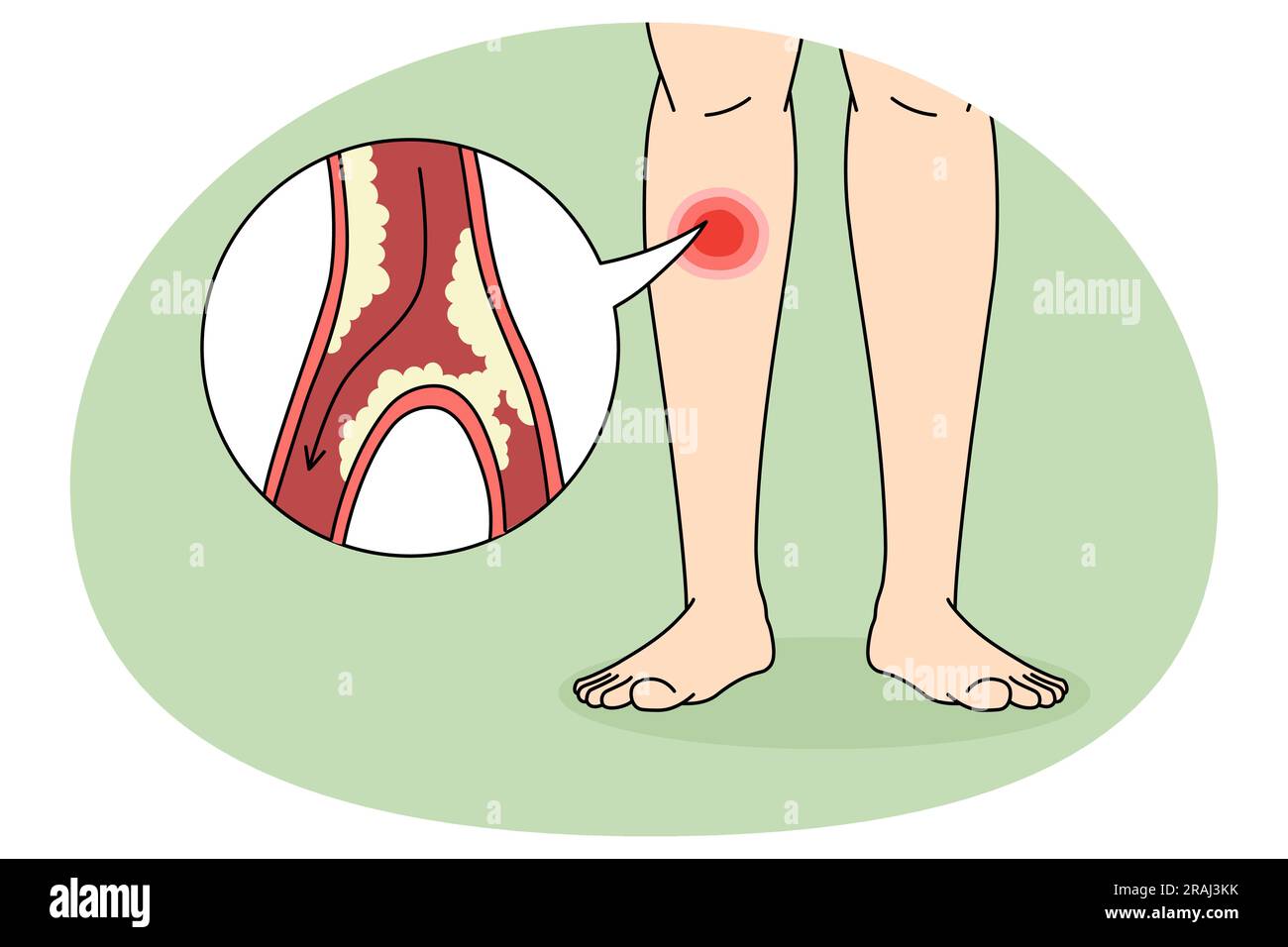 Close up of person suffer from PAD disease having blood vessel blockage in legs. Man struggle with clotted limbs from veins narrowing or blocking. Healthcare concept. Vector illustration. Stock Vector
