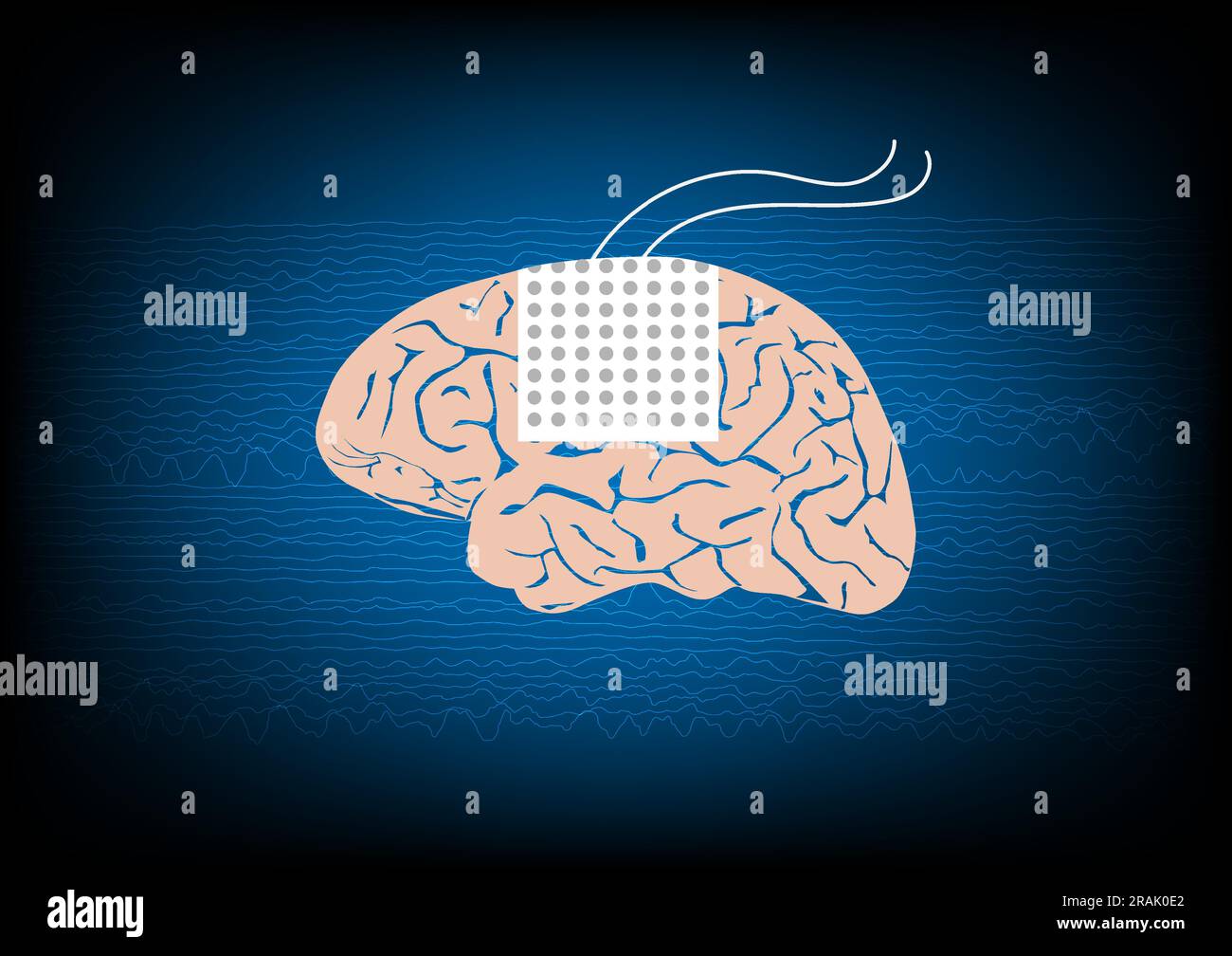 Illustration of subdural electrode over brain surface for EEG or brain